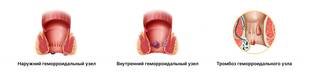 Тромбоз геморроидальных узлов