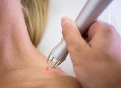 dermatologist-removing-mole-from-womans-shoulder 1.jpg