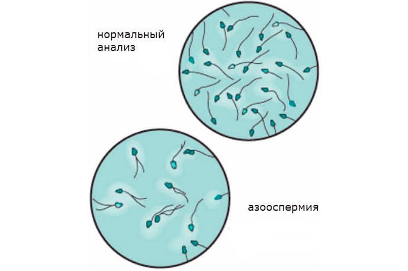нормальный анализ и азоспермия