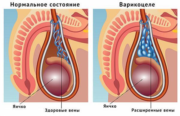 Лечение варикоцеле в Краснодаре. Клиника УРО-ПРО